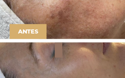 Tratamientos para eliminar manchas faciales: preguntas frecuentes